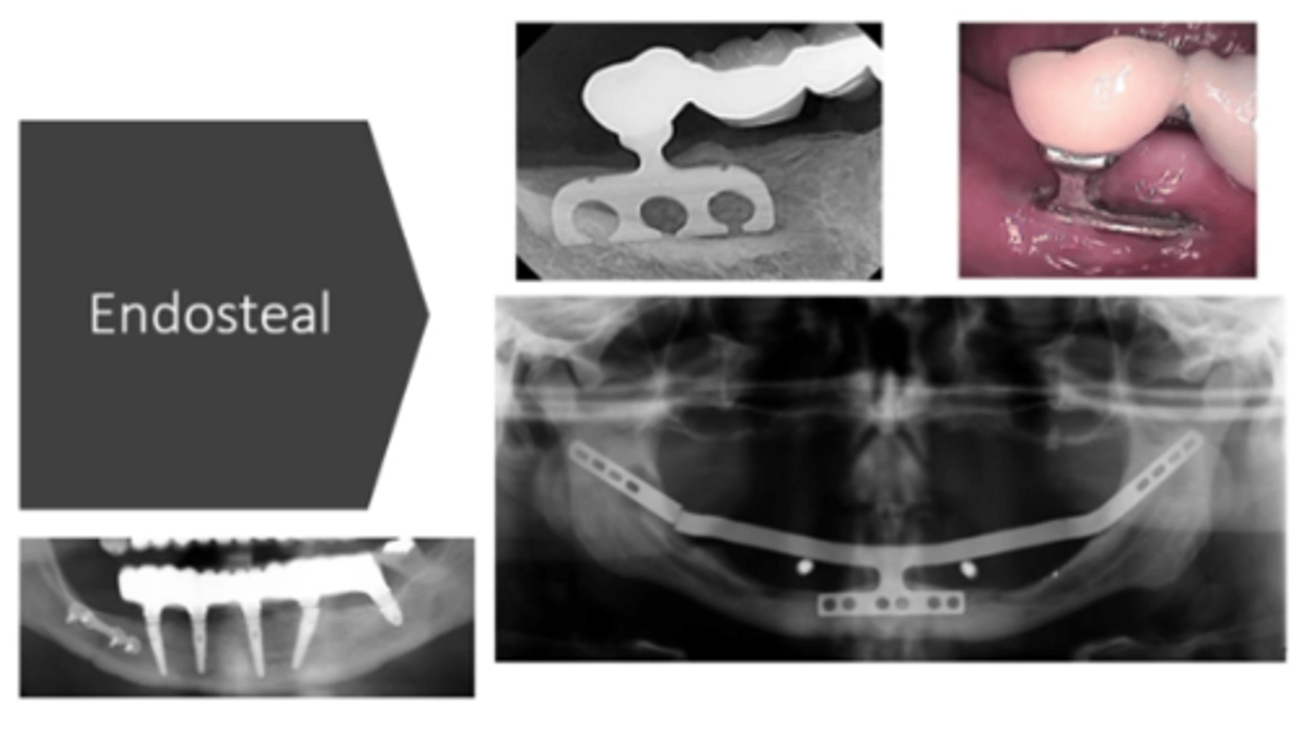 <p>- Contemporary dental implant</p><p>- Surgically placed in the bone &amp; can be used to replace a single tooth/multiple teeth</p><p>in pic: root form, blade, ramus frame</p>