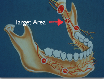<p>which injection technique?</p>