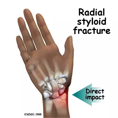 <p>fracture of radial styloid process </p>