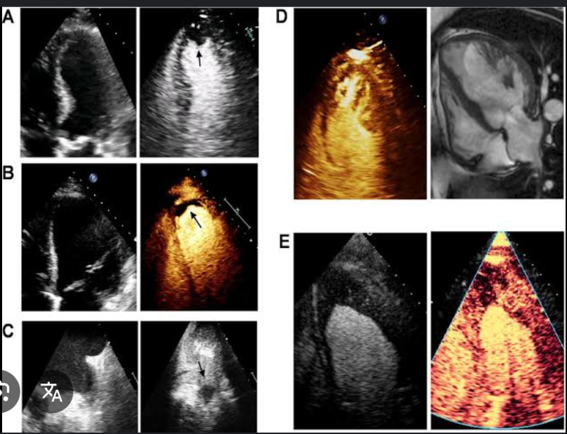 <p>Visualization of the rightsided chambers of the heart is enhanced by the injection of contrast agents.</p>