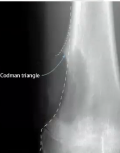 <p>What is codman’s triangle?</p>
