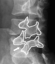 <p>SCOTTY DOG FRACTURE</p>