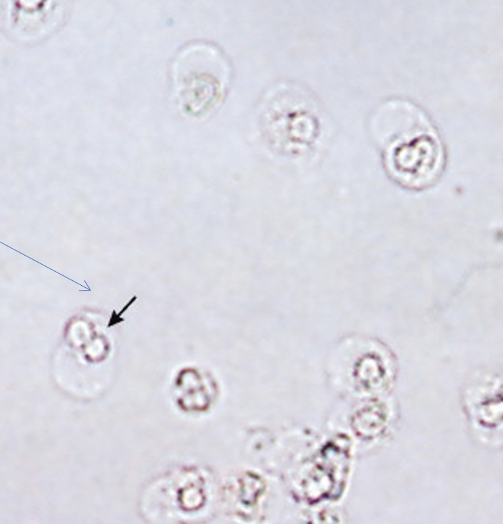 <p>What type of cell is shown from this urinalysis? What does it indicate?</p>