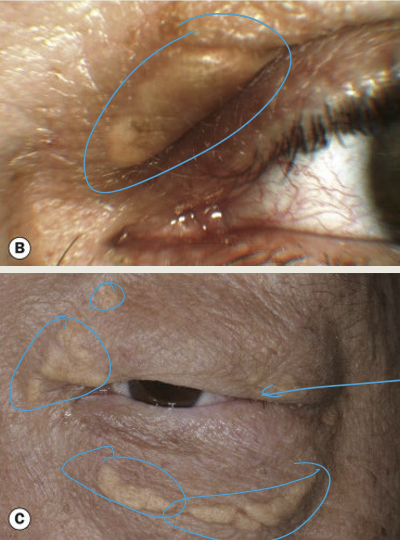 <p>A benign condition characterized by the development of soft, semisolid, yellow papules or plaques containing cholesterol</p>