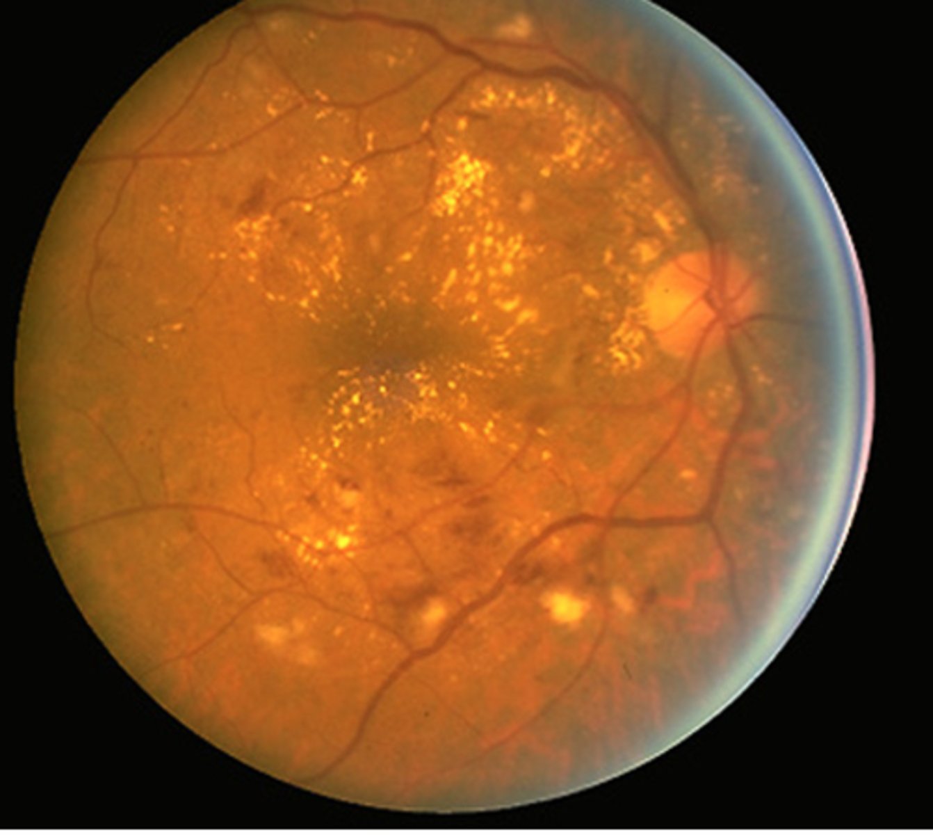 <p>non proliferative and early fundoscopic changes associated with diabetes</p>
