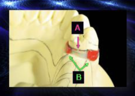 <p>what type of blockout is B?</p>