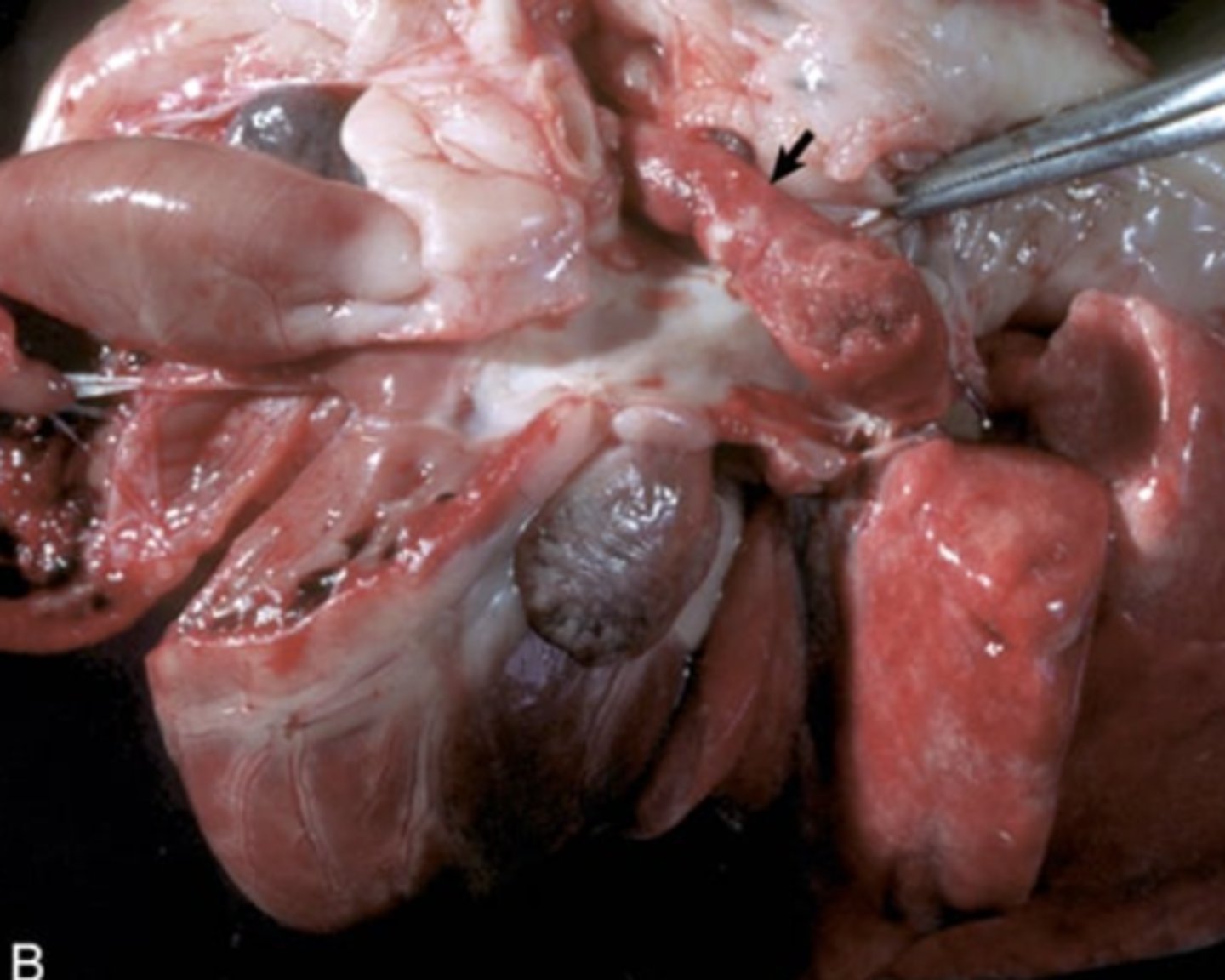 <p>What type of thrombus is being shown in this photo?</p><p>arterial or venous</p>