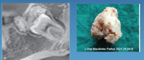 <p>irregular mass of RO, common in posterior mandible </p>