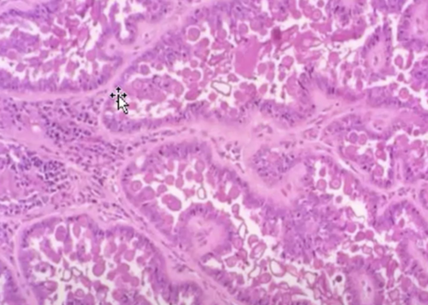 <p>What has caused this histologic appearance of this liver?</p>