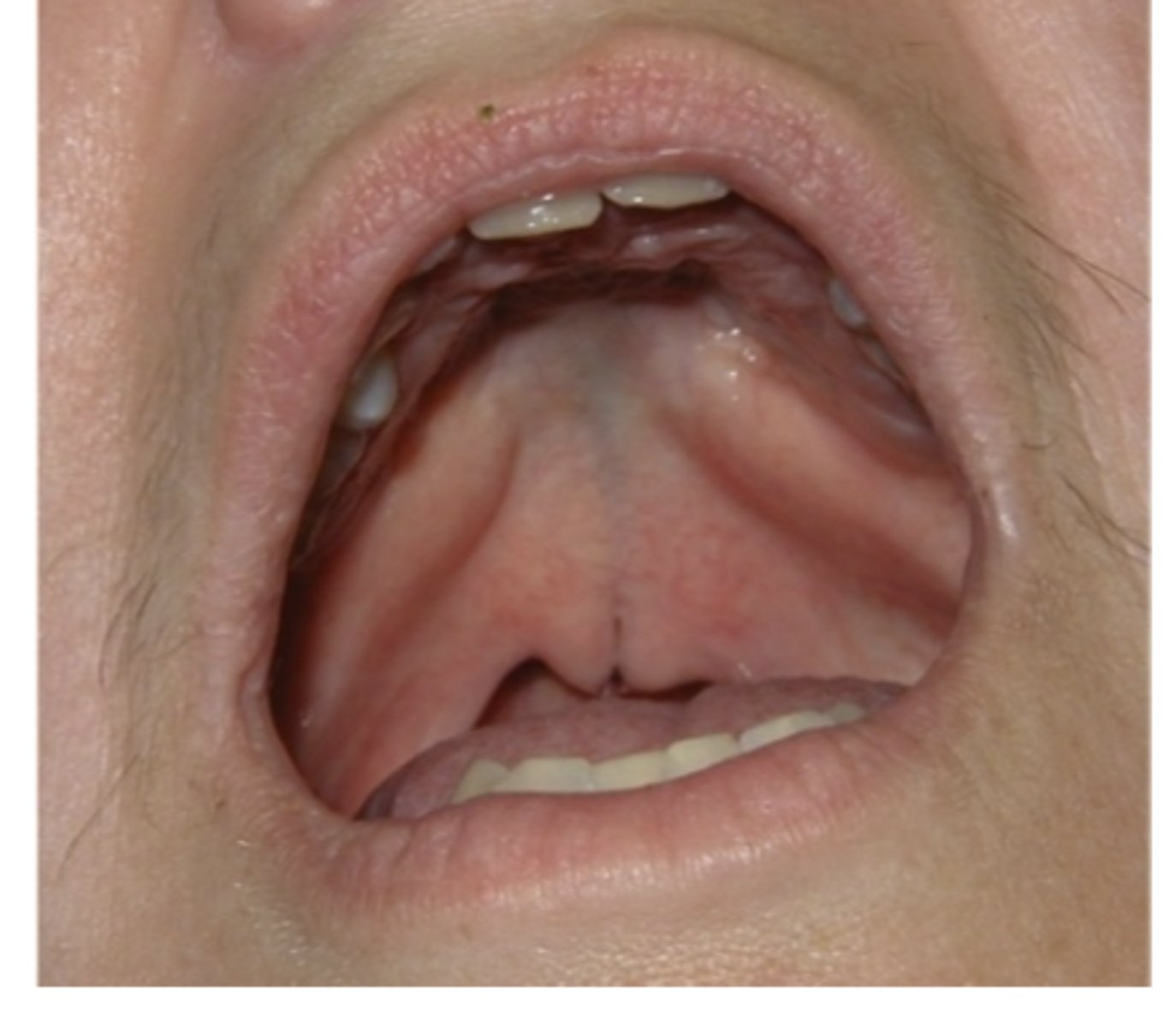 <p>What is submuscous palatal cleft defect in? </p>