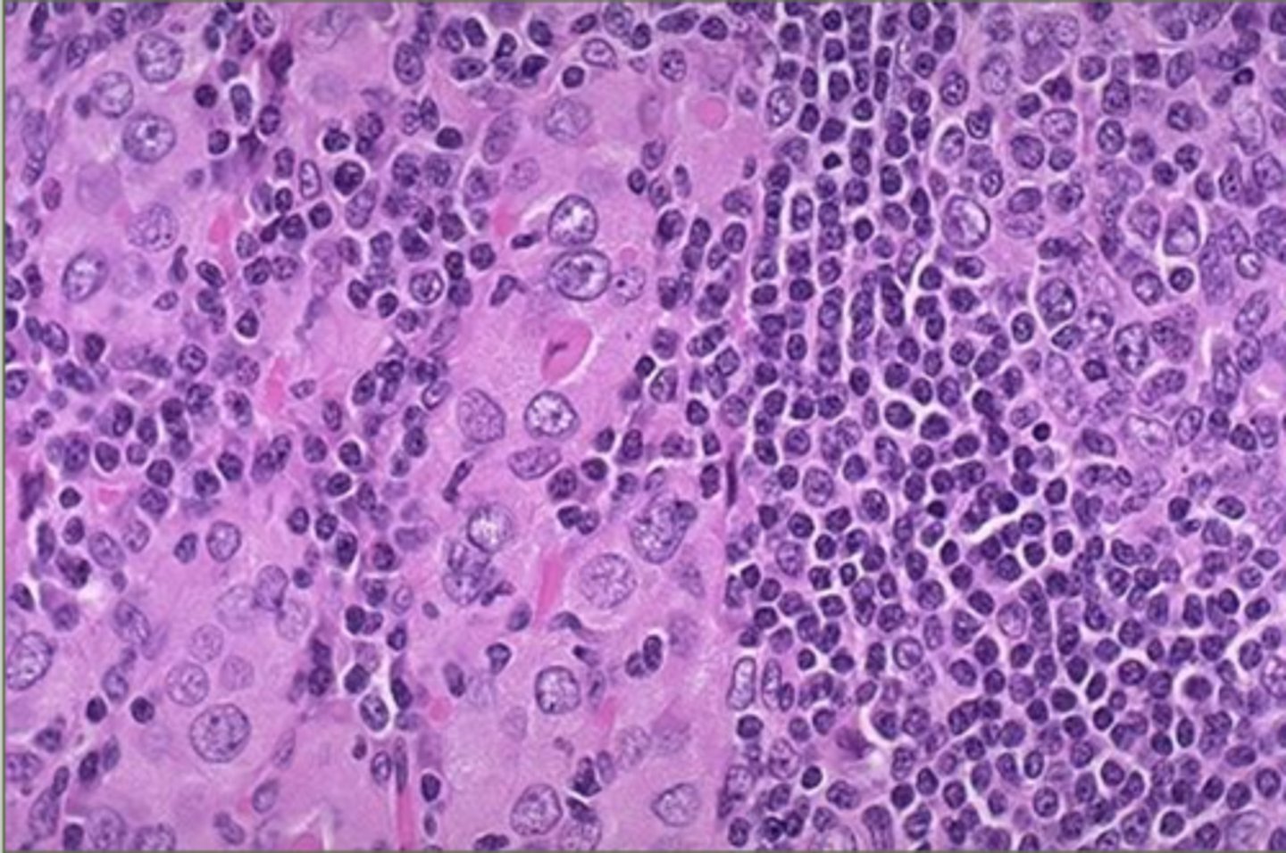 <p>What is happening to this thyroid tissue</p>