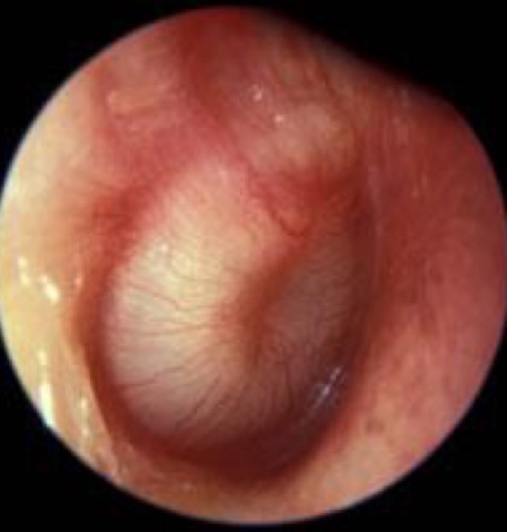 <p>Comment on this tympanic membrane</p>