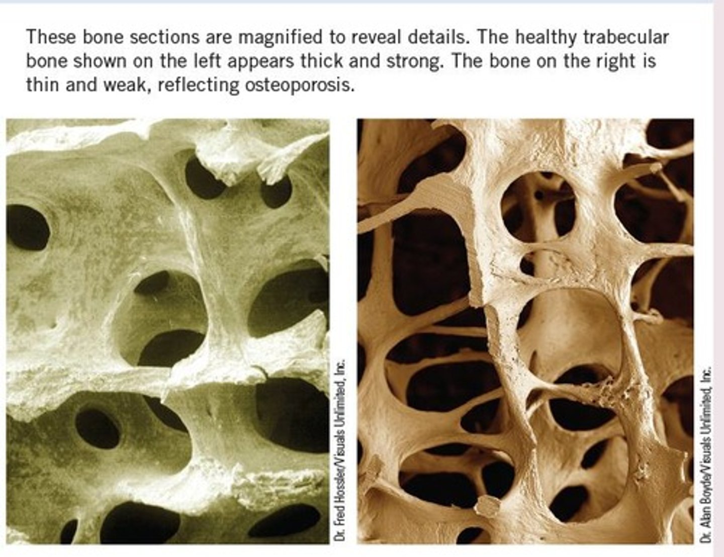 <p>A condition characterized by bone loss that develops silently over years, leading to increased fracture risk.</p>