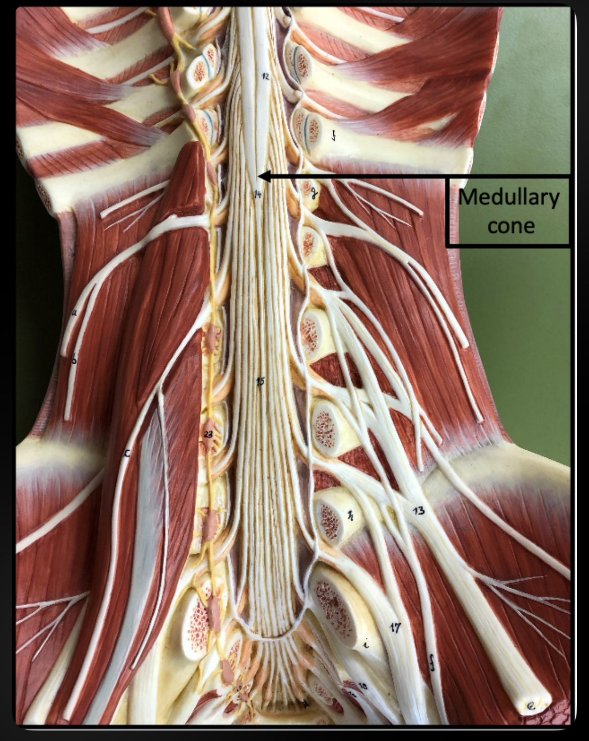 <p>Conus Medullaris</p>