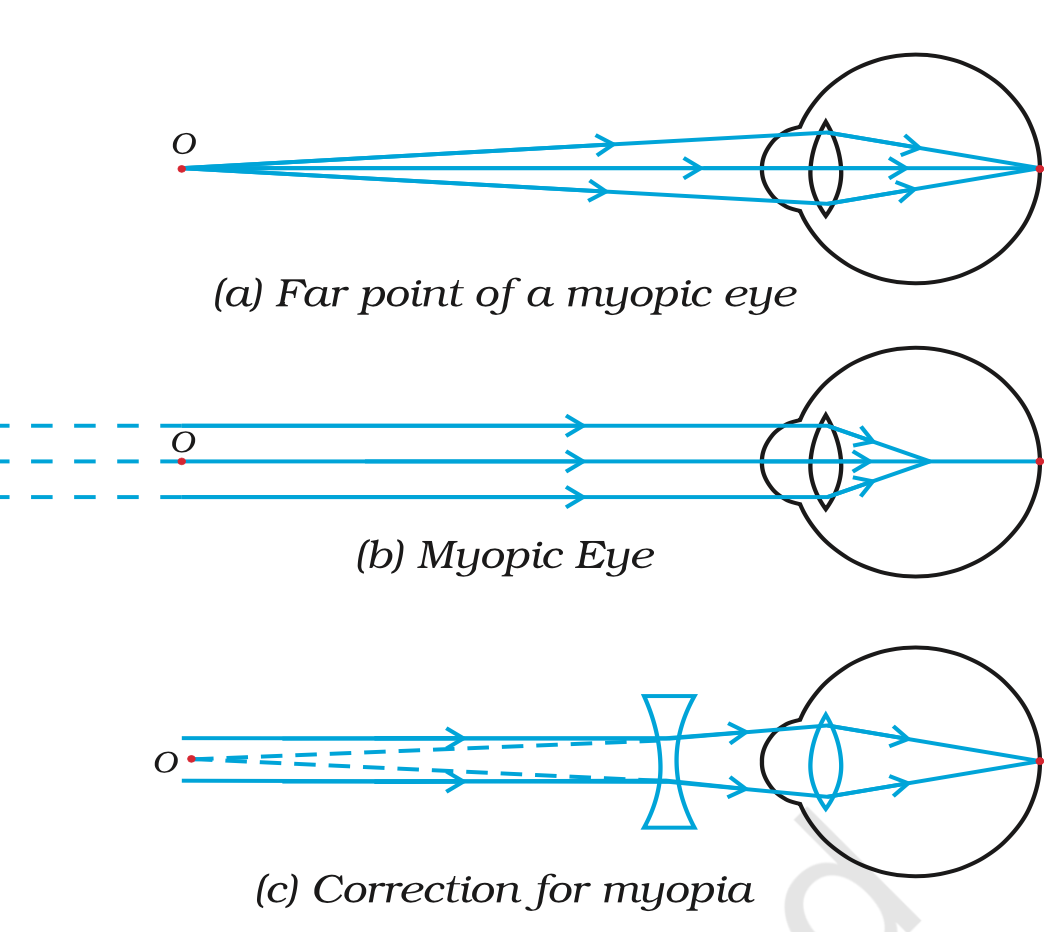 <ol><li><p>Also known as short sightedness or near sightedness. It is when a person cannot see far away objects clearly but can do so for nearby objects.</p></li><li><p>The image is formed before the retina.</p></li><li><p>It can be caused by the increase in curvature and power of the lens or the elongation of eyeballs.</p></li><li><p>It can be corrected by using a concave lens as it has the opposite power and can help cancel out the excessive positive power</p></li></ol><p></p>