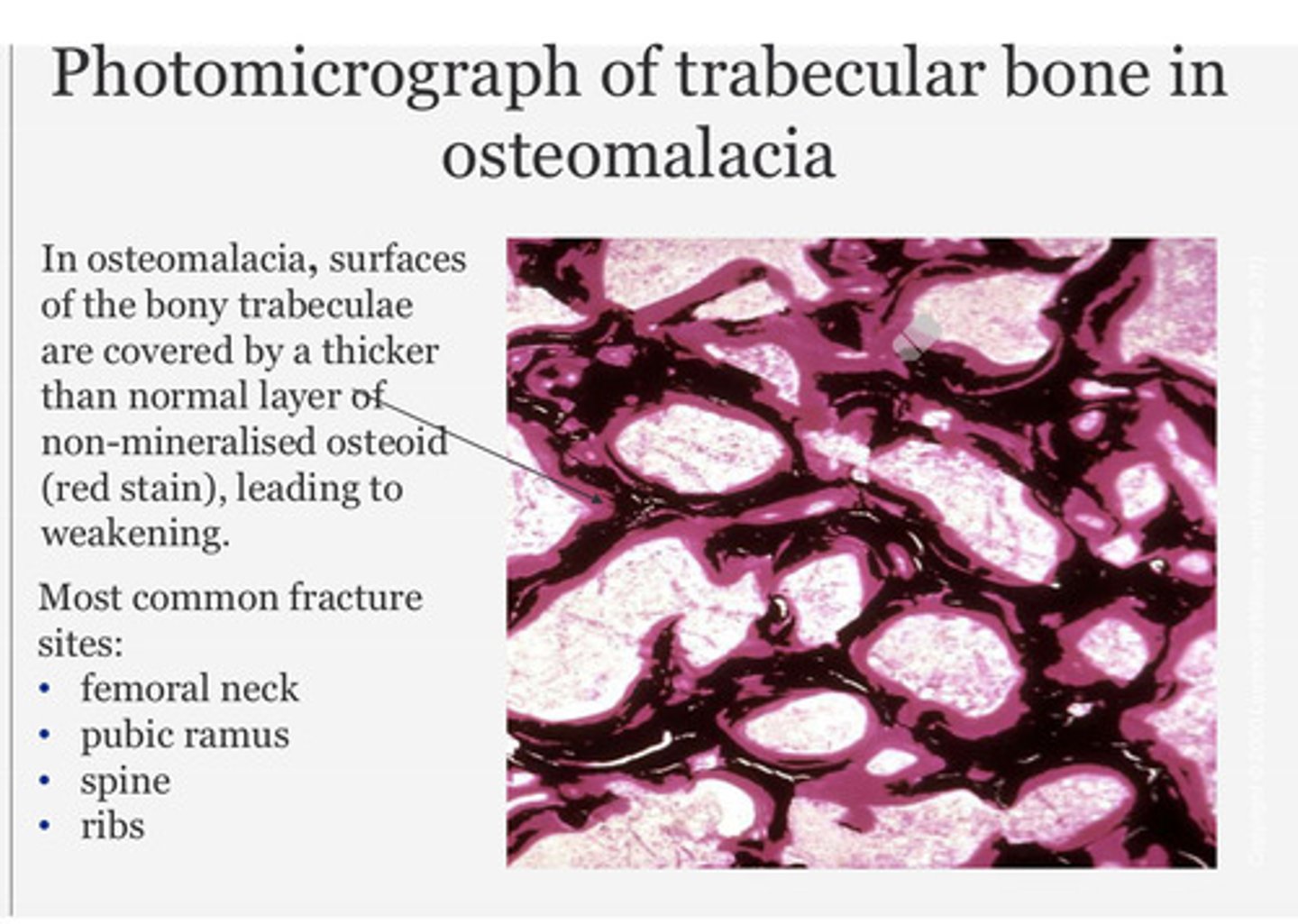 <p>In osteomalacia - surfaces of the bony trabeculae are covered by a thicker than normal layer of non-mineralised osteoid (red stain) leading to weakening.</p>