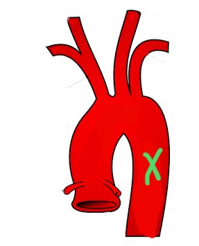 <p>Supplies blood to thorax, abdomen, and lower body.</p>