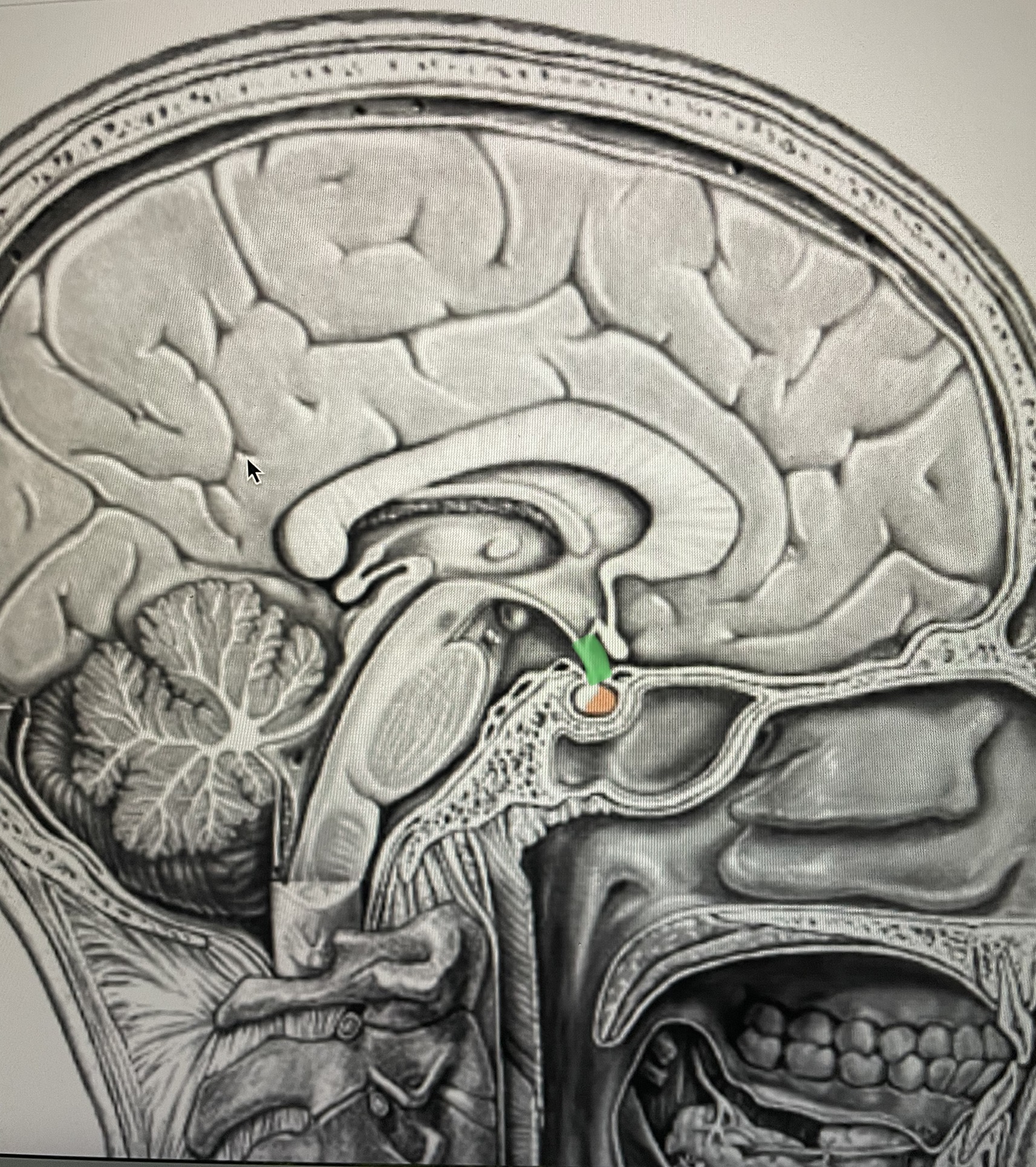 <p>green/ stalk btwn pituitary and hypothalamus</p>