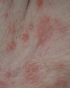 <p><span>Elevated Fluid Filled Primary Lesions</span></p>