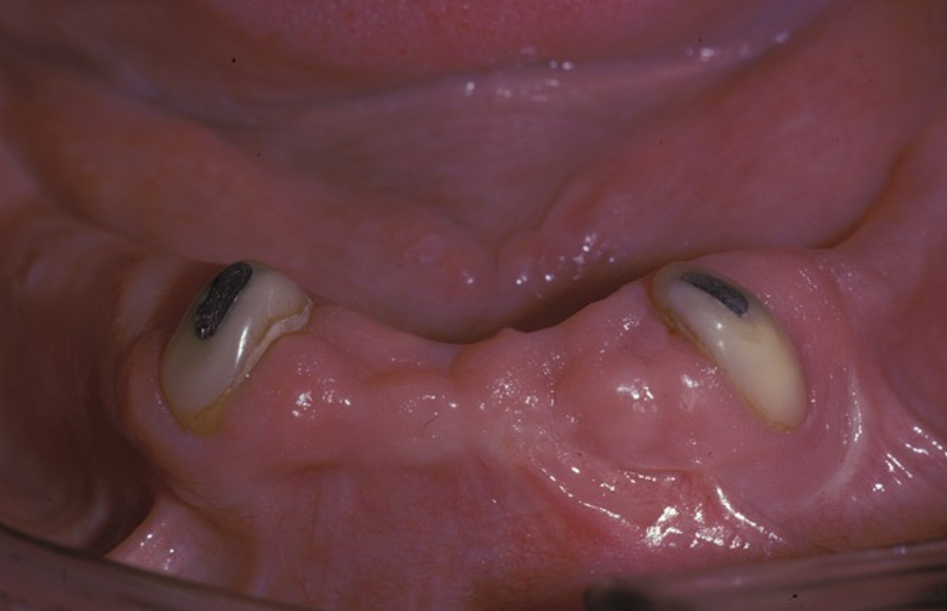 <p>Leave a few teeth like some canines leave good teeth might be  a1st bicuspi dor canine to provide extra support</p>