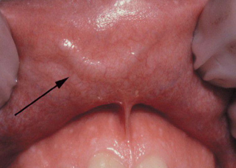 <p><span style="color: #000000">Common vascular anomaly seen in adults</span></p><ul><li><p><span style="color: #000000">Main arterial branch extends up into the superficial submucosal tissue</span></p></li><li><p><span style="color: #000000">Almost exclusively on upper lip</span></p></li><li><p><span style="color: #000000">Elevated linear or arcuate lesion</span></p></li><li><p><span style="color: #000000">Stretching the lip usually causes the artery to become inconspicuous</span></p></li><li><p><span style="color: #000000">Unique feature is pulsation</span></p></li><li><p><span style="color: #000000">No treatment, brisk bleeding</span></p></li></ul><p></p>