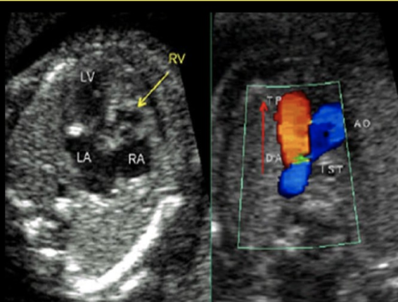 <p>a small, undeveloped right ventricle, right atrium and pulmonary artery are collectively referred to as </p><p>a) noonan syndrome</p><p>b) ebstein anomaly</p><p>c) double outlet right ventricle</p><p>d) hypoplastic right heart syndrome </p>
