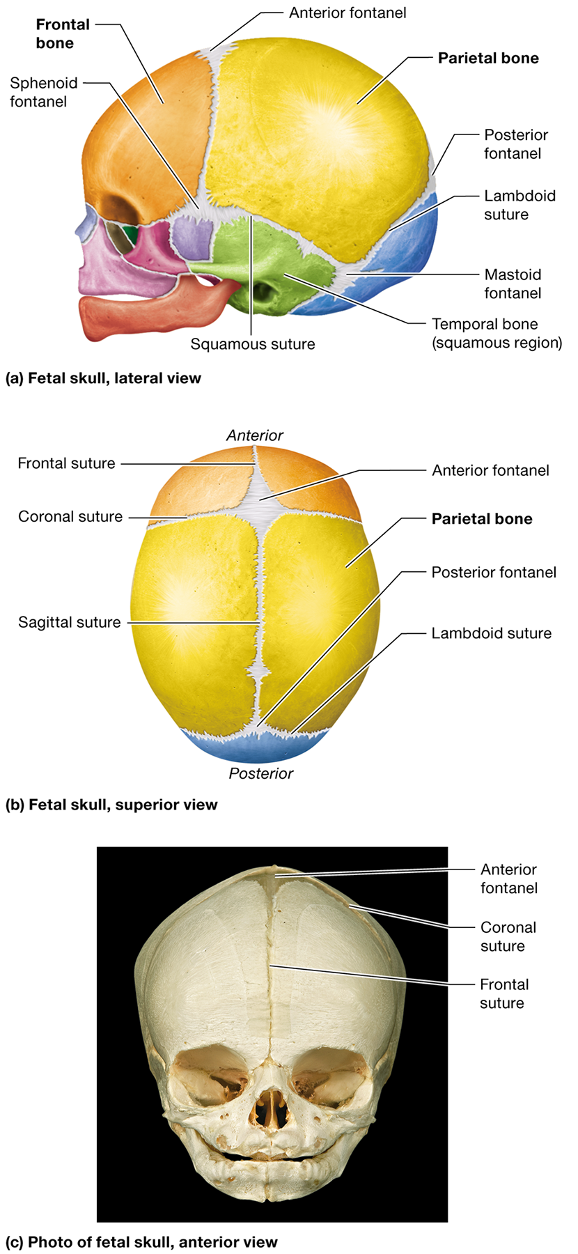 <p><span>where the <strong>parietal bones meet the frontal bone</strong></span></p>