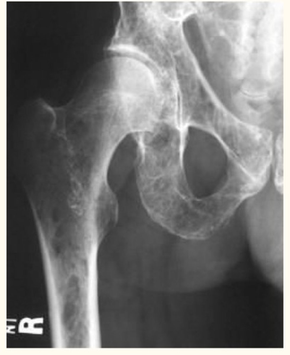 <p>High antibody level, osteolytic lesions in bones</p>