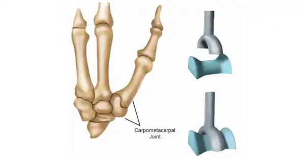 <p>carpometacarpal of thumb</p>