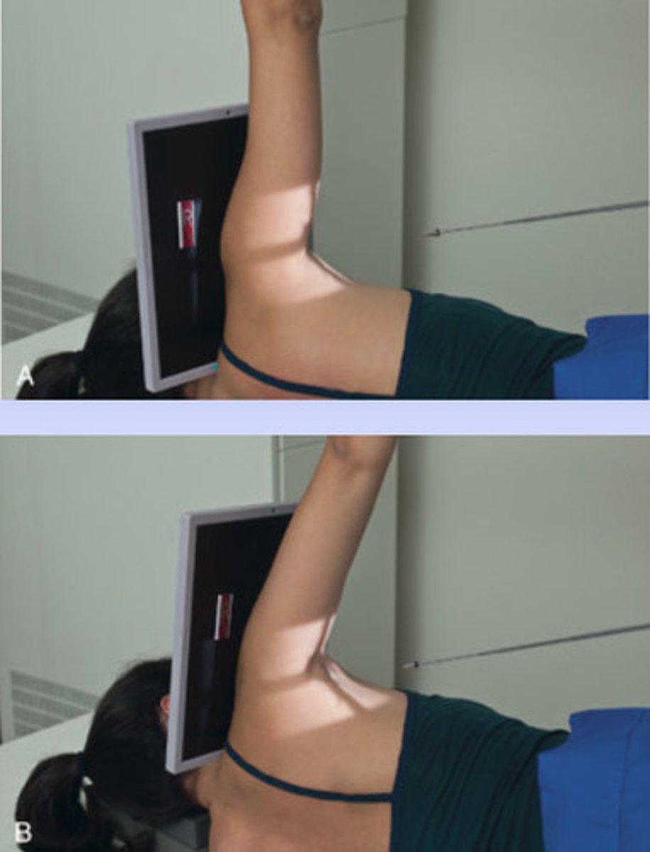 <p>hill-sachs defect, if patient cannot abduct arm 90° then angle CR 5-10°</p>