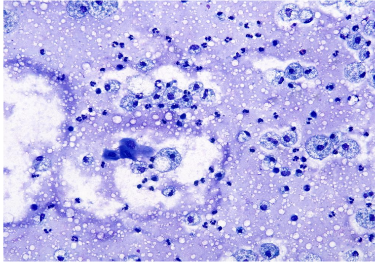 <p>exudate</p>