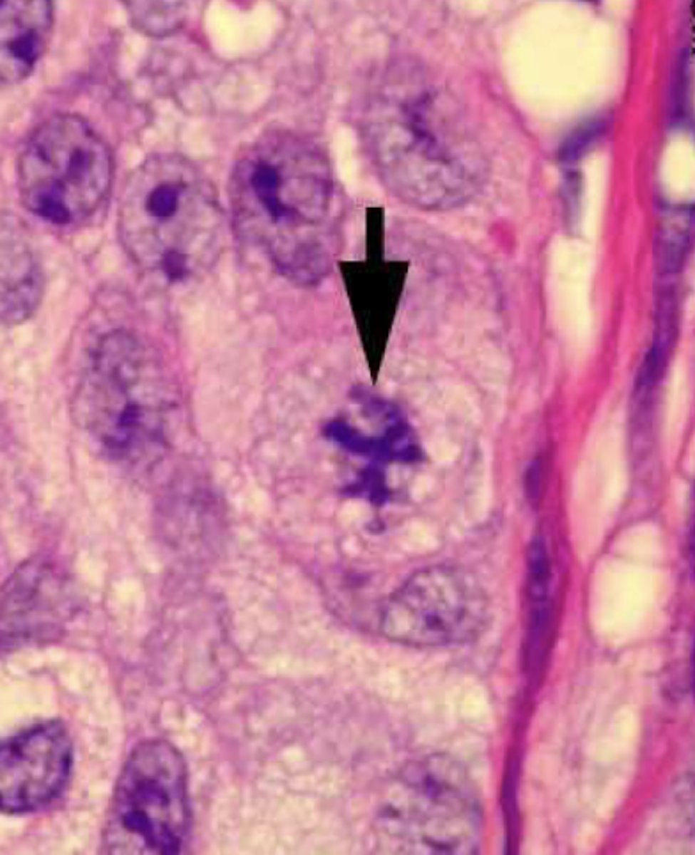 <p>is this a normal or cancerous cell?</p>