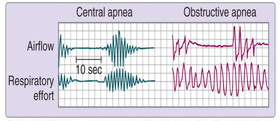 <p>Interpret PSG graph.</p>