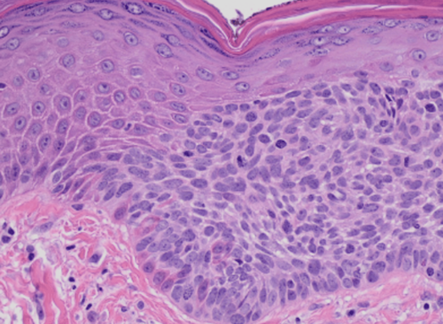 <p>What type of cellular adaptation is shown in this photo?</p>