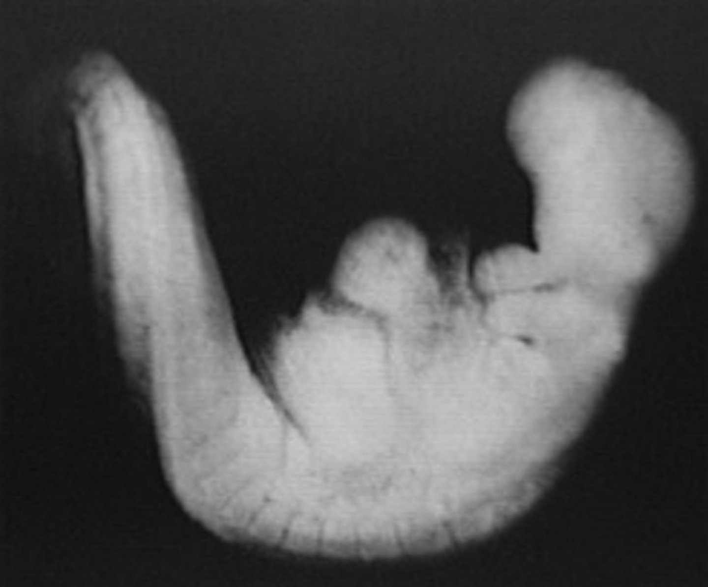<p>Not seen sonographically</p><p>C-shaped</p><p>Forebrain prominence</p><p>Tail</p>