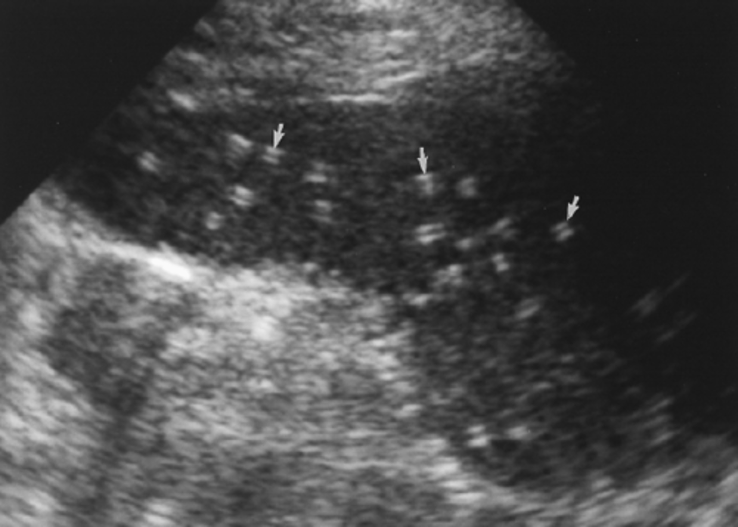<p>It is fairly common to see small ___ dots in the spleen. This is usually referred to as ___. They may or may not be noted on the report.</p>