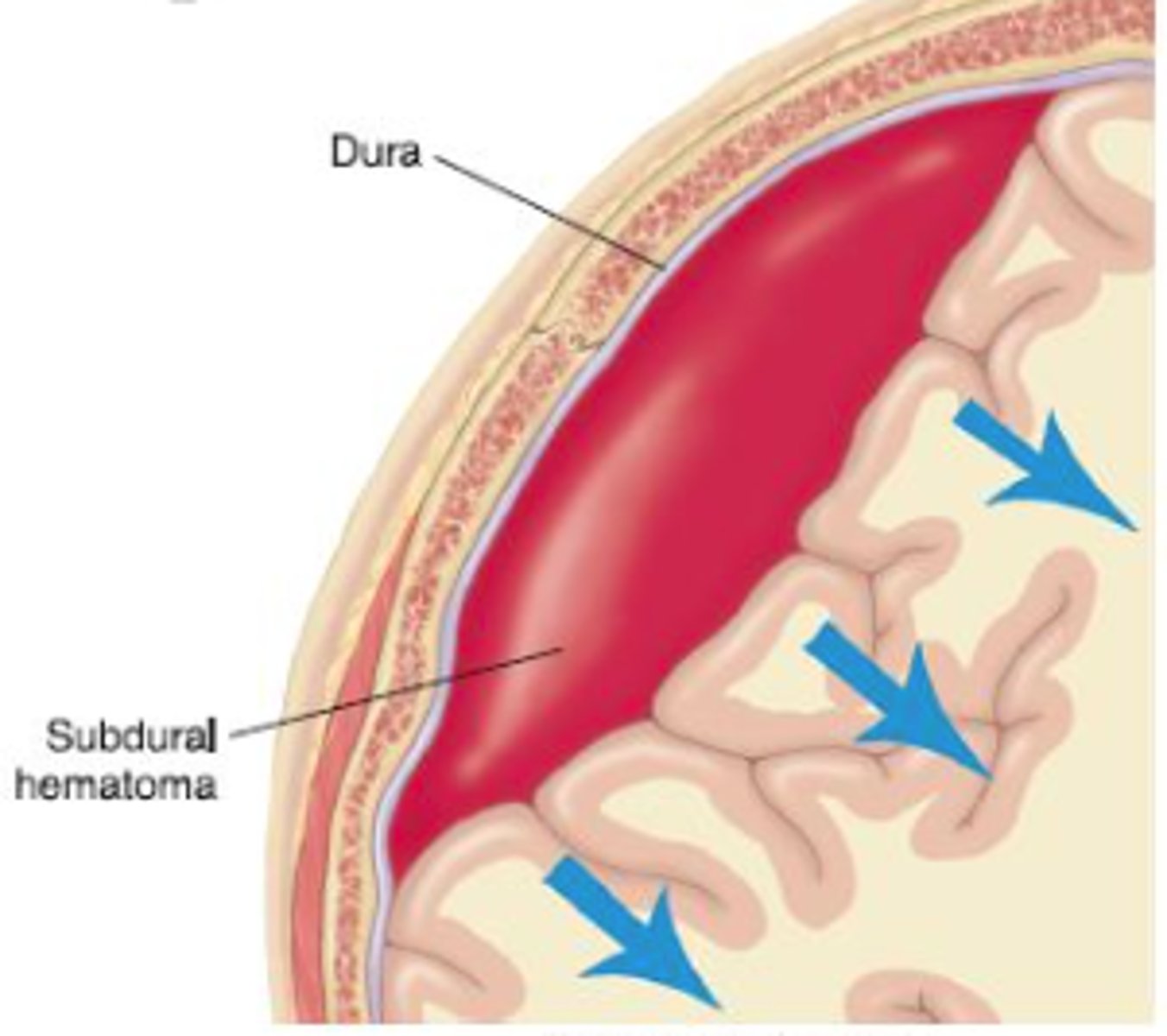 <p>Accumulation of blood between the inner dura mater &amp; arachnoid mater due to tearing of the bridging veins, often caused by acceleration-deceleration injuries or trauma (esp. in the elderly)</p>
