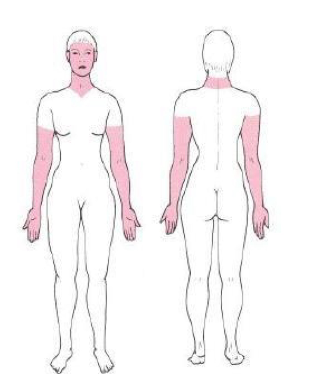 <p>what distribution of skin lesion is this </p>