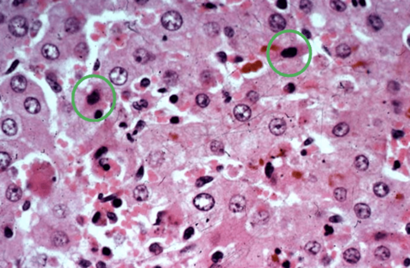 <p>This is an image showing a cell undergoing necrosis. What type of nuclear changes are occuring?</p>