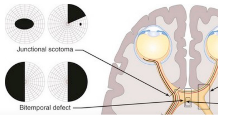 <p>The location of the lesion in <strong>comparison to the optic chiasm</strong> determines the location of the defect </p><p>If the lesion is <strong>directly below</strong> the chiasm, the resulting defect is a <strong>bitemporal </strong>field defect. </p><p>If a lesion affects the <strong>anterior or the posterior portion</strong> of the chiasm as it connects to the optic nerve or optic tract, respectively, it may result with an<strong> anterior junctional scotoma</strong> or a <strong>posterior junctional scotoma</strong></p>