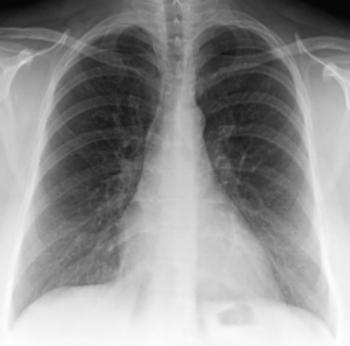 <p>For Case 6-10 (Figure 6-28), which of the following</p><p>studies would be least useful today?</p><p>A. Chest CT</p><p>B. Left hip x-ray</p><p>C. Bone scan</p><p>D. Skeletal survey</p><p>E. Mammography</p>