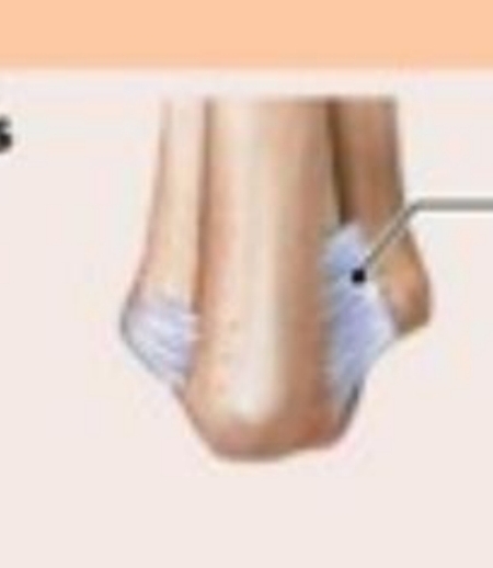 <ul><li><p>Amphiarthroses joint (Limited movement joint)</p></li><li><p>FIBROUS</p></li><li><p>Bones connected by ligament</p></li><li><p>Ex. Distal joint b/w the tibia &amp; fibula</p></li></ul>