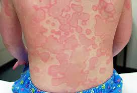 <p>A delayed allergic response by the immune system against a large amount of foreign protein or hapten that have entered the bloodstream.</p><p>a. Anaphylactic reaction</p><p>b. Pseudo-allergic reactions</p><p>c. Serum sickness</p><p>d. Lupus-like syndrome</p>