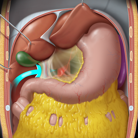 arises as an anterior fold of the serous of the stomach and duodenum connecting the stomach and duodenum to the liver