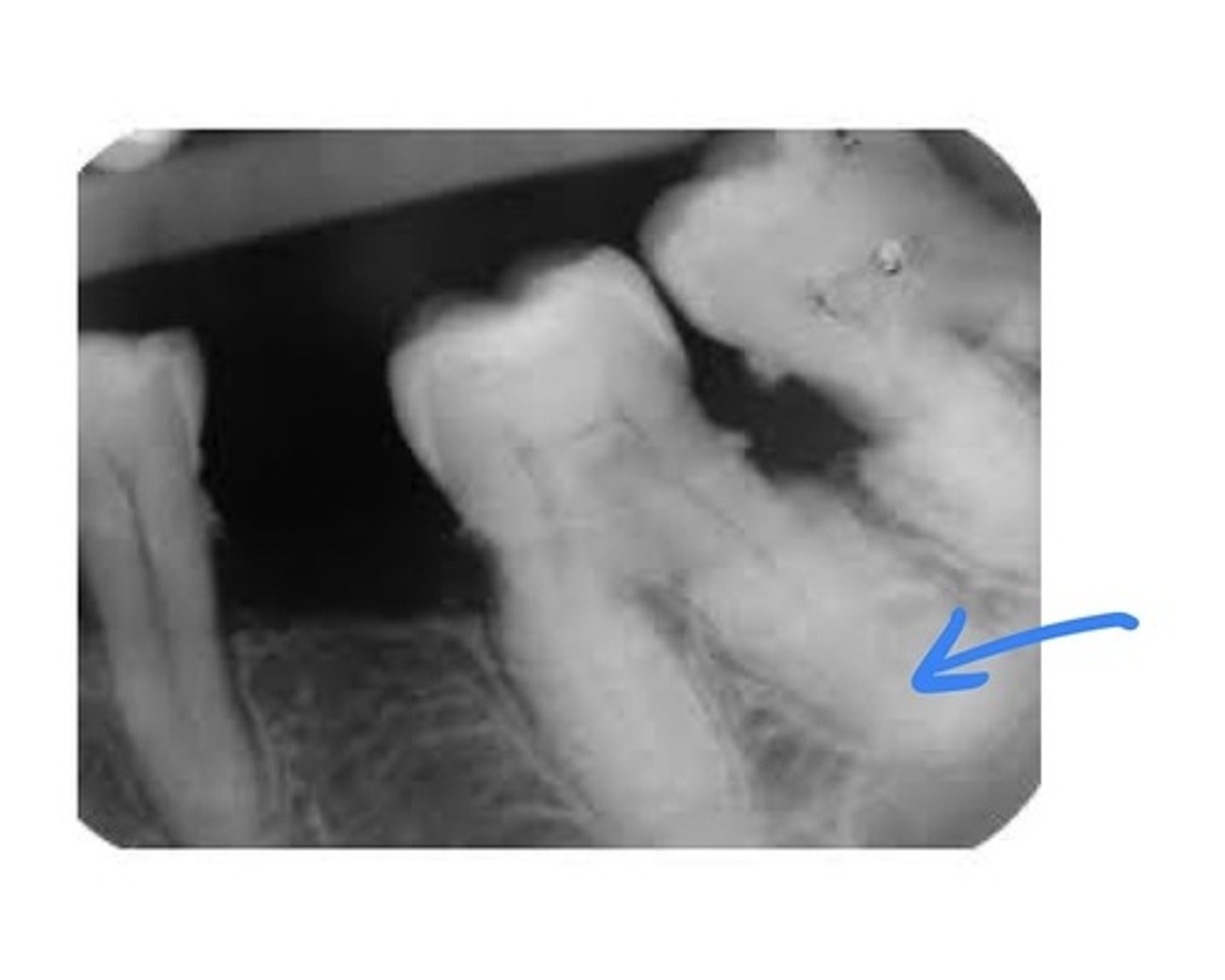 <p>Excessive cementum on the roots of the teeth. occurs in adults; incidence and amount increase with age. Feature associated with several local and systemic factors. No treatment necessary.</p>
