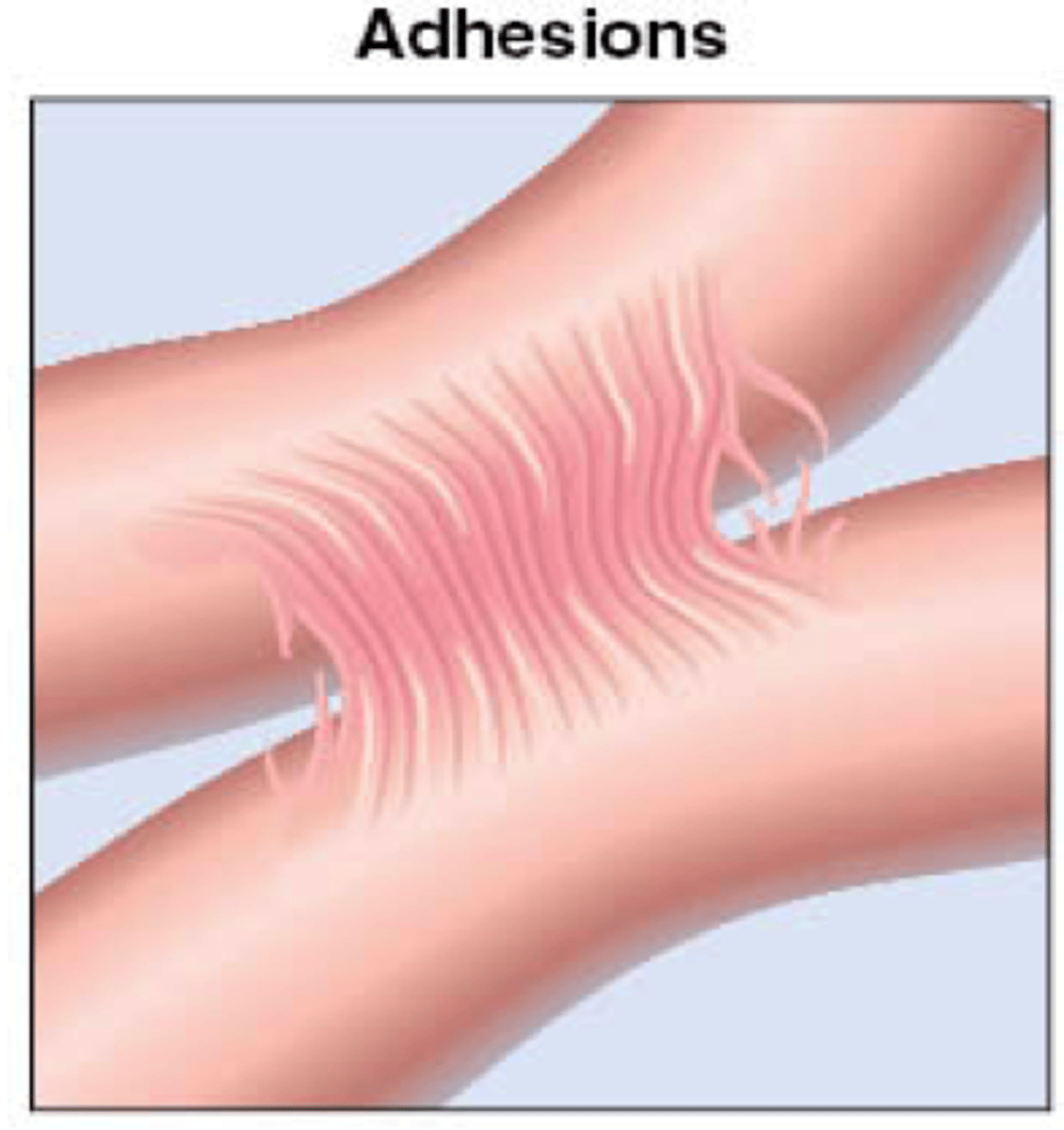 <p>tissues grown together that are normally separate</p>