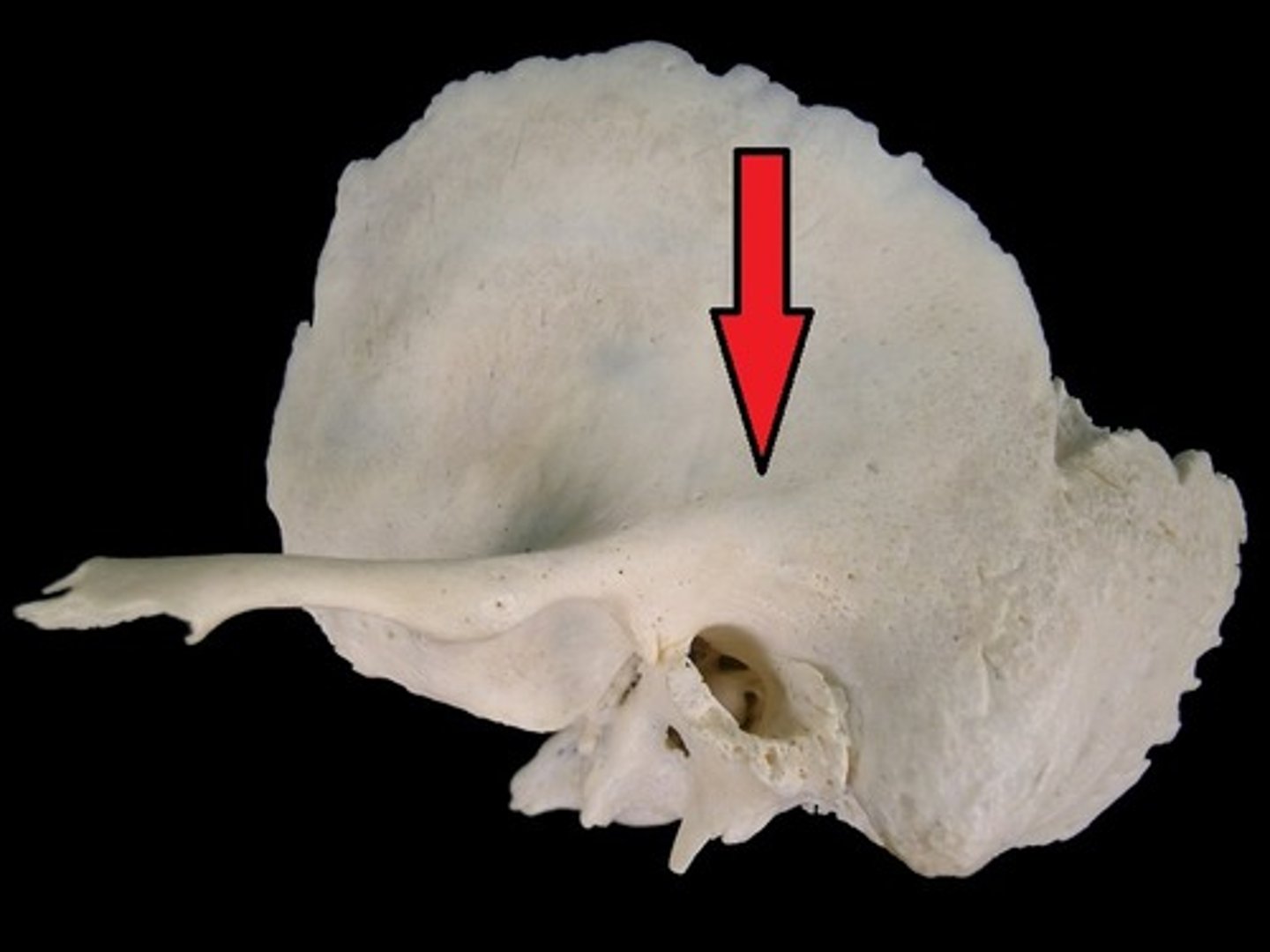 <p>posterior extension of the suprameatal crest, above mastoid, <mark data-color="yellow" style="background-color: yellow; color: inherit">farther back than suprameatal crest</mark></p>
