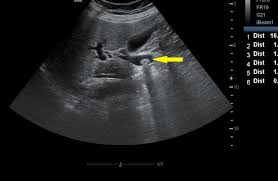 <p>Choledocholithiasis </p><ul><li><p>Bile duct &gt;6mm </p></li><li><p>Intrahepatic duct dilatation </p></li><li><p>Distended Gallbladder </p></li><li><p>+/- pancreatic duct dilation </p></li><li><p>Stones in gallbladder </p></li></ul><p></p>