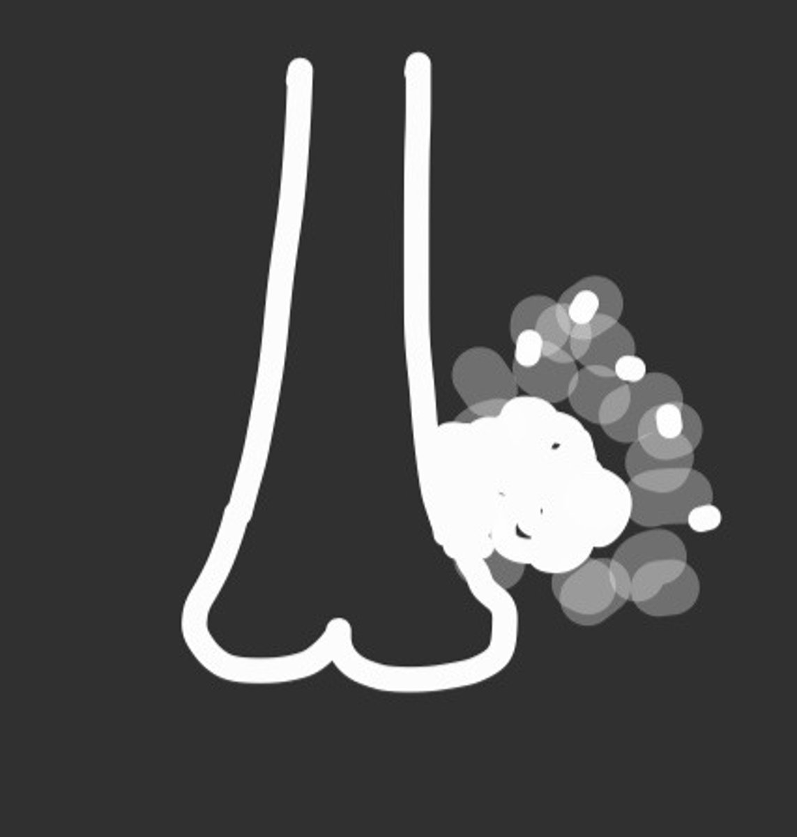 <p>patient is young and this is painful</p><p>what tumour is represented?</p>