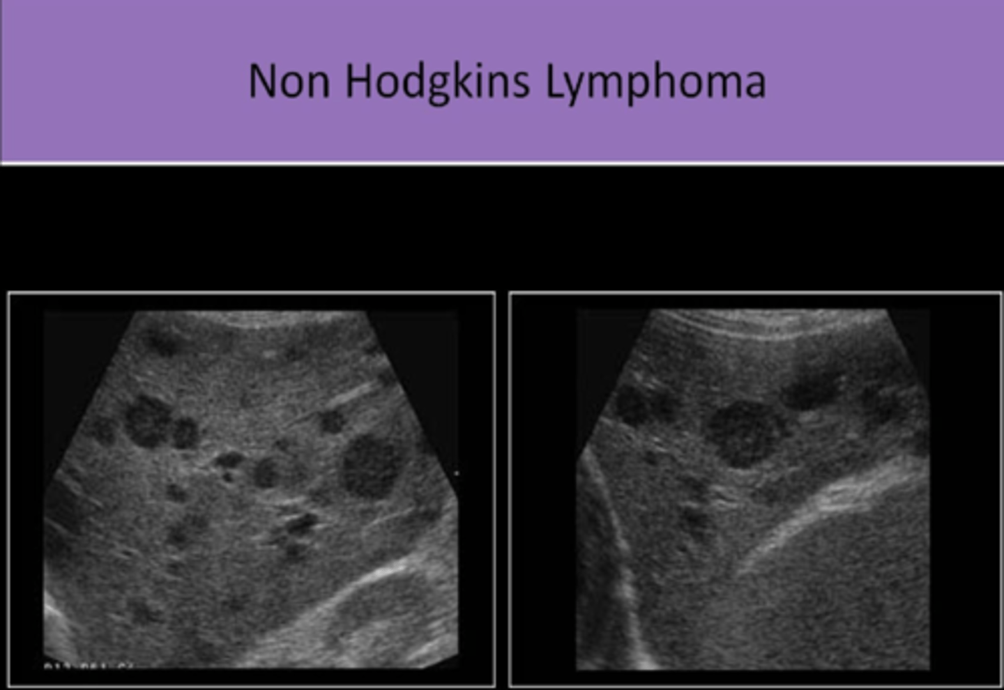 <p>1. malignancy of the LYMPHATIC SYSTEM<br>2. commonly associated with HIV/AIDs<br>3. SOLID<br>4. may be SINGLE OR MULTIPLE<br>5. HYPOECHOIC and/or COMPLEX appearance</p>